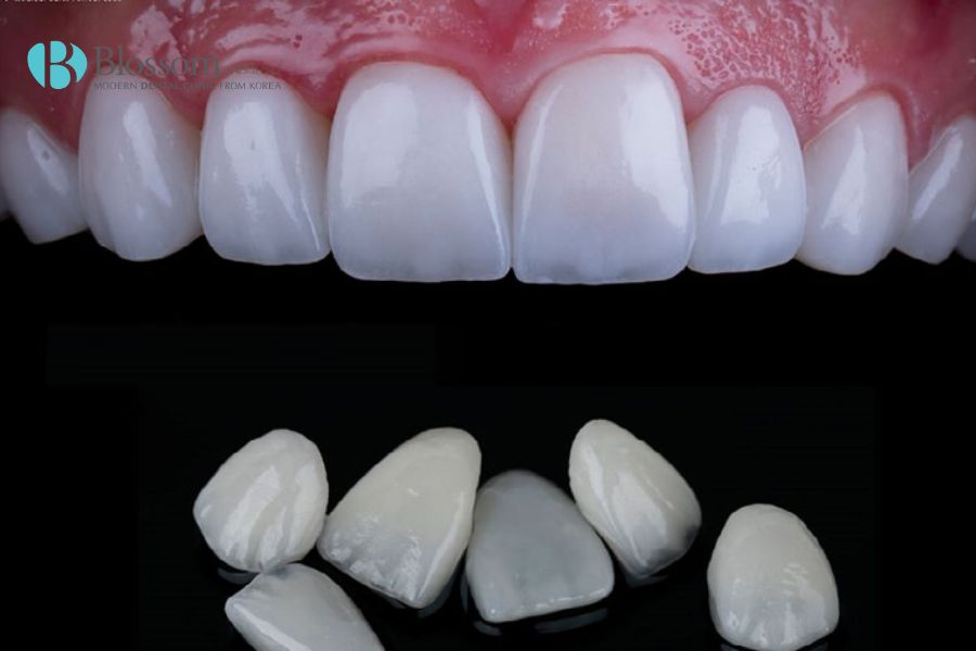 Chất lượng răng là một trong những yếu tố cần quan tâm khi lựa chọn nha khoa để dán sứ