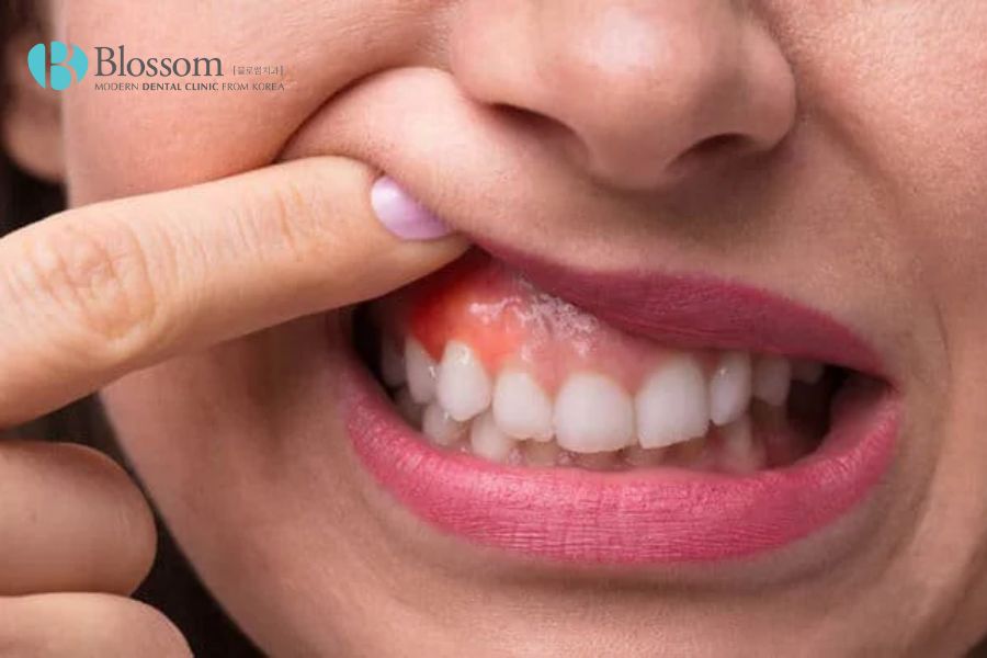Chảy máu chân răng là một trong những biểu hiện thường gặp của viêm chân răng.