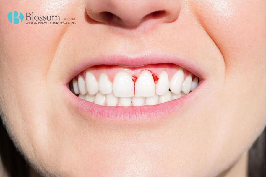 Chảy máu chân răng xảy ra khi ổ viêm lợi bị vỡ. 