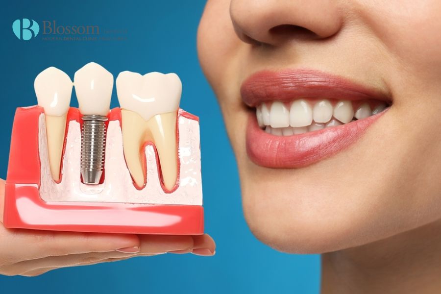 Chi phí trồng răng Implant phụ thuộc vào nhiều yếu tố