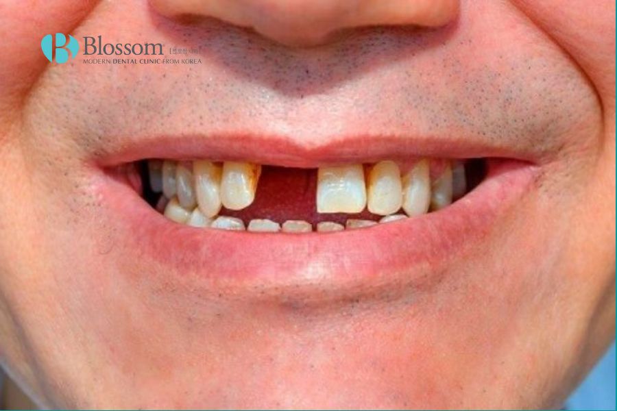 Chủ quan trong việc chăm sóc nướu dẫn đến tình trạng mất răng.