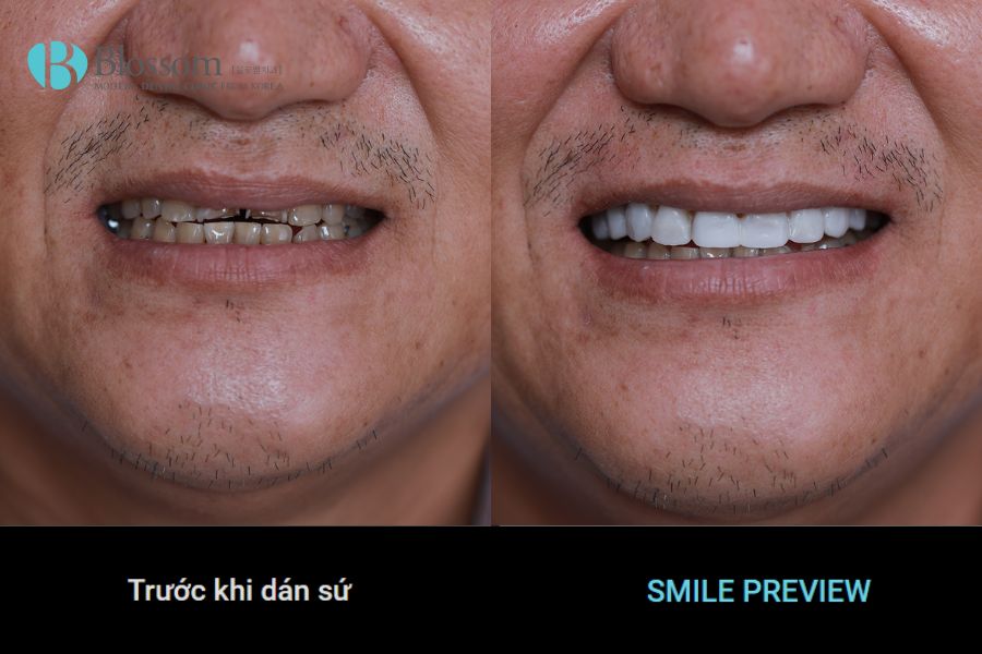 Công nghệ tiên tiến Slime Preview từ New York giúp khách hàng nhận thấy thay đổi hình dáng răng trước khi dán sứ
