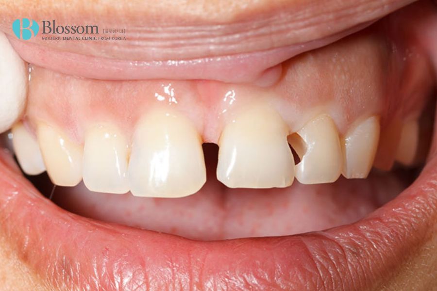 Dán mảnh vỡ lại chỉ áp dụng với trường hợp vết mẻ răng cửa nhỏ, không ảnh hưởng đến tủy răng.