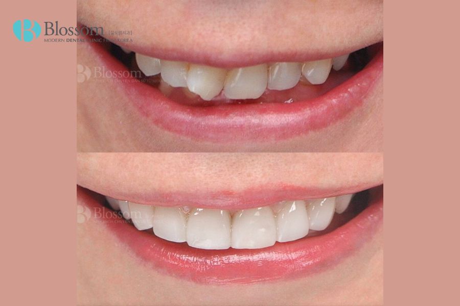 Dán mặt răng sứ với kỹ thuật dán Lamifilm không gây đau đớn, ít xâm lấn đến cấu trúc của răng thật