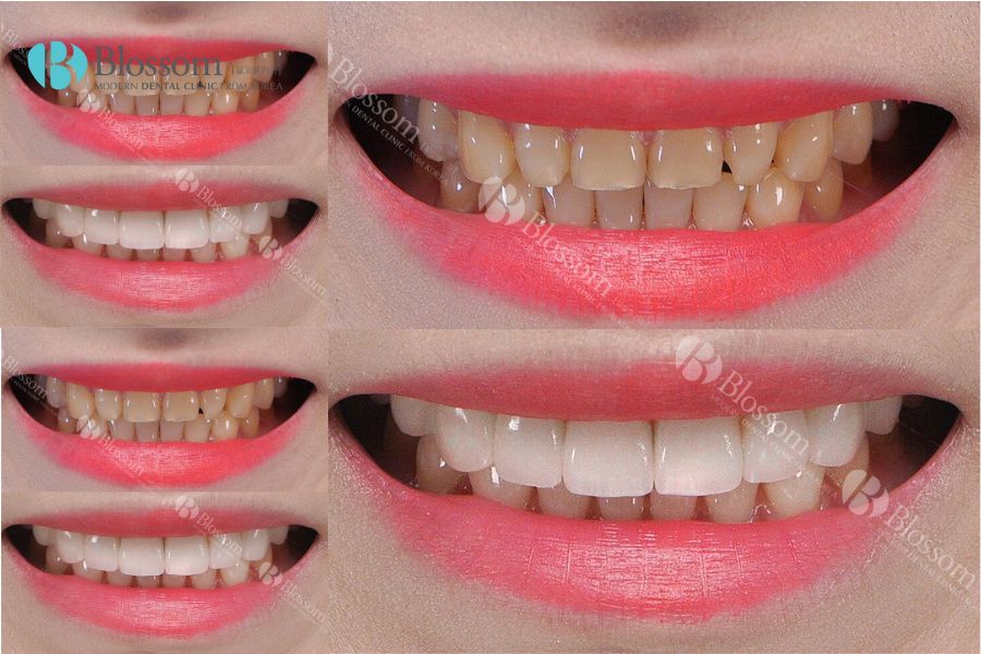 Dán sứ răng giúp bảo tồn răng gốc, mang lại tính thẩm mỹ cao