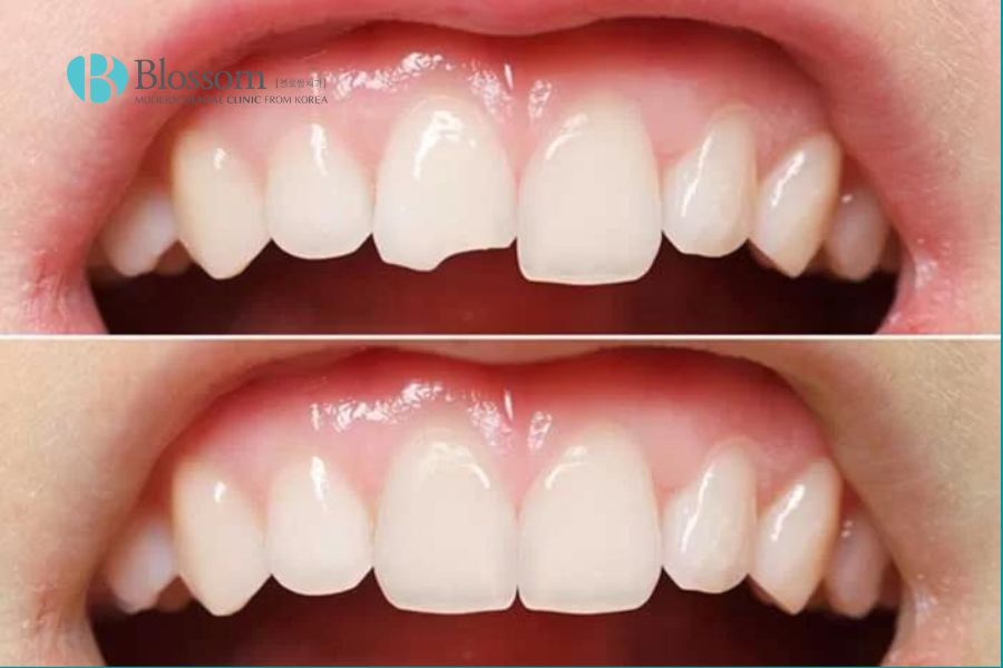 Trám răng là giải pháp hiệu quả trường hợp răng bị gãy nhẹ, còn chân răng.