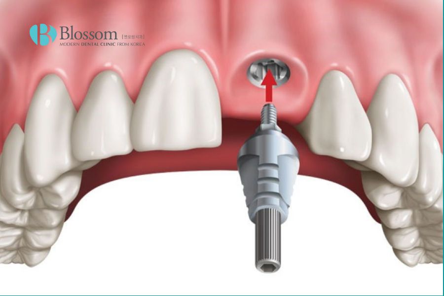 Cấy ghép implant phù hợp tình trạng răng cửa gãy nặng, mất chân răng.