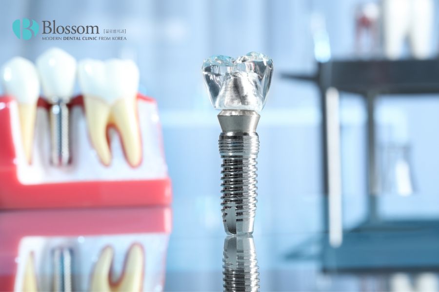 Giá trồng răng Implant giá rẻ có thể do trụ Implant kém chất lượng