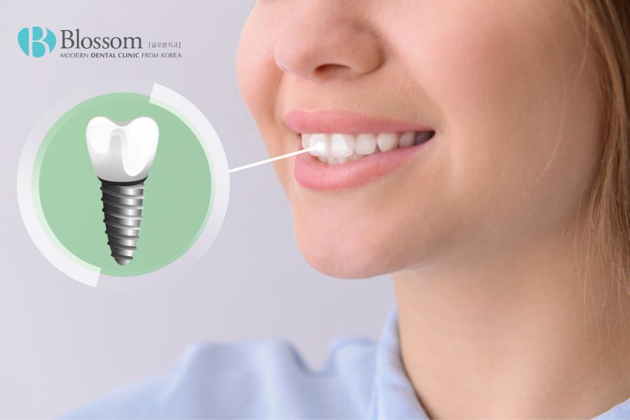 Giá trồng răng Implant phụ thuộc vào nhiều yếu tố khác nhau