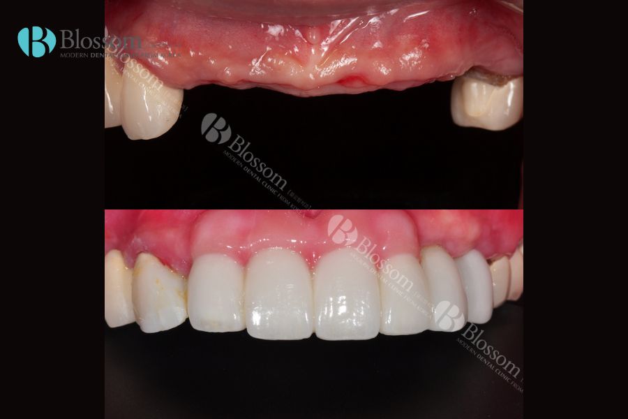 Hàm răng trắng đều sau khi cấy ghép Implant