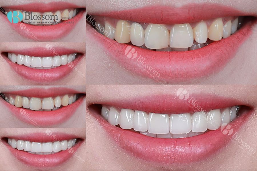 Hiệu quả vượt trội với phương pháp dán răng sứ Lamifilm tại Nha Khoa Blossom