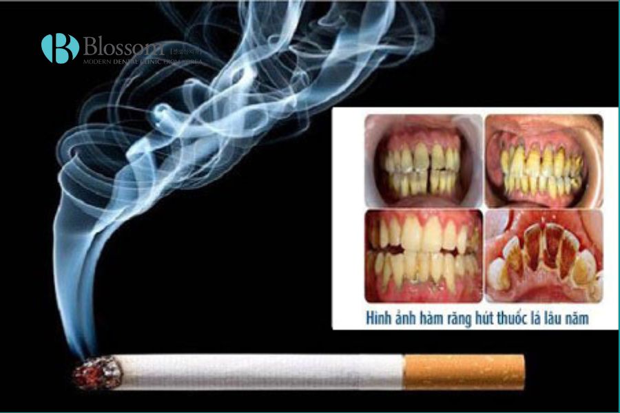 Hút thuốc lá khiến nướu trở nên nhợt nhạt, dễ bị tổn thương và thâm đen.