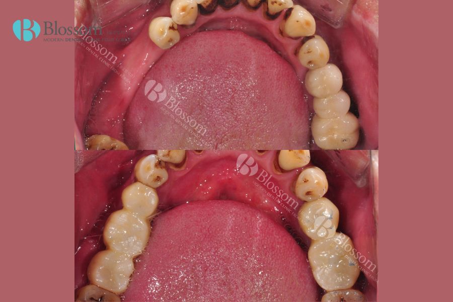 Khả năng ăn nhai tốt sau quá trình trồng răng Implant