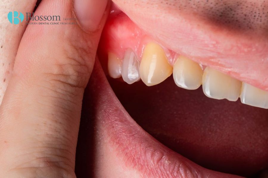 Khi bị viêm chân răng, tốt nhất bệnh nhân nên kịp thời đến nha khoa để được thăm khám, tư vấn điều trị.