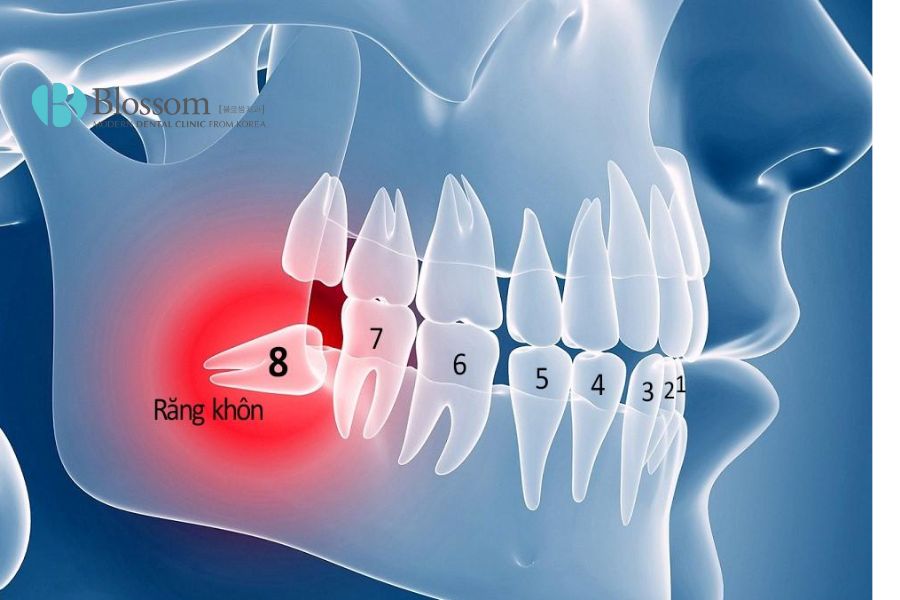 Khi mọc răng khôn, bạn có thể bị đau nhức hàm phải.