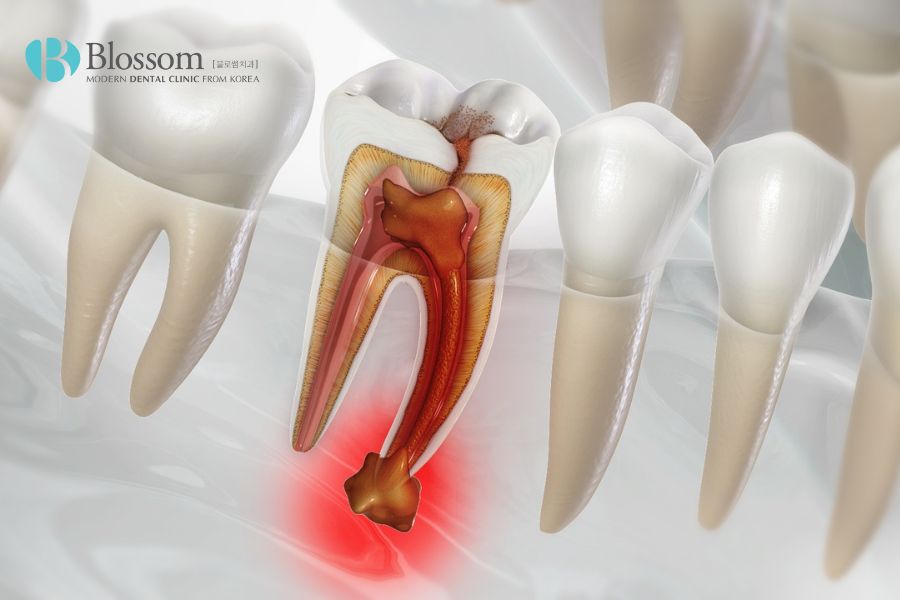 Khi ổ áp xe lan rộng, trầm trọng, nha sĩ có thể cân nhắc nhổ răng.