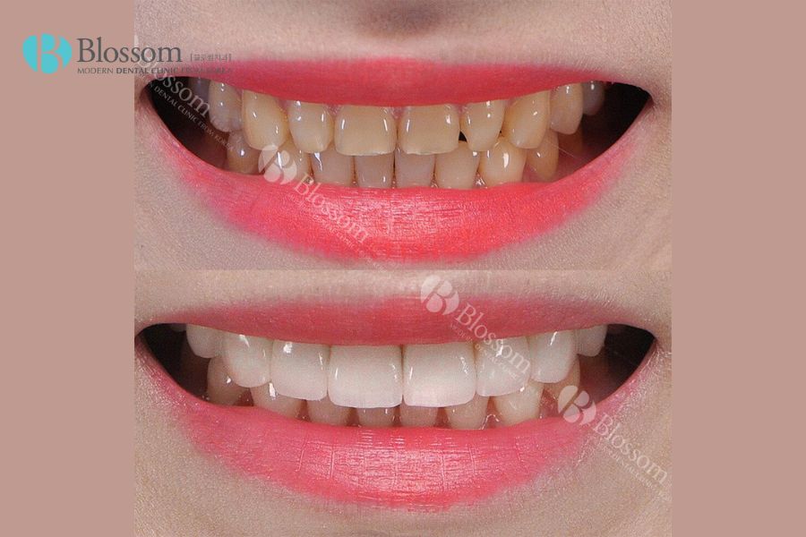 Kỹ thuật dán sứ Lamifilm với độ bền cao, hạn chế việc răng sứ bị mòn