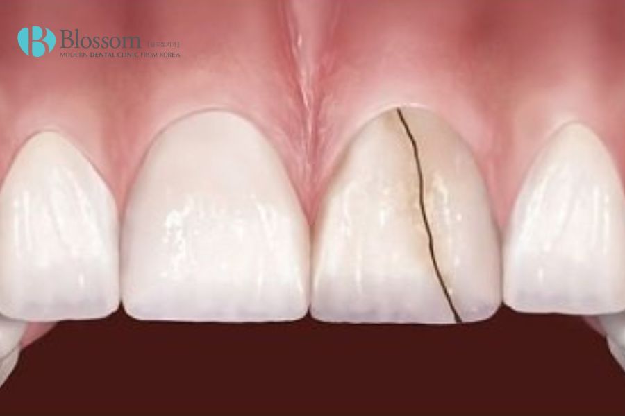 Làm răng sứ giá rẻ dễ xảy ra nguy cơ răng sứ bị vỡ