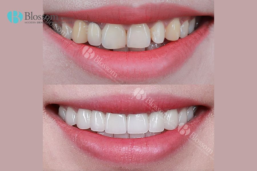 Làm răng sứ không mài hỗ trợ cải thiện khuyết điểm của răng như hư tổn, ố vàng, xỉn màu,...