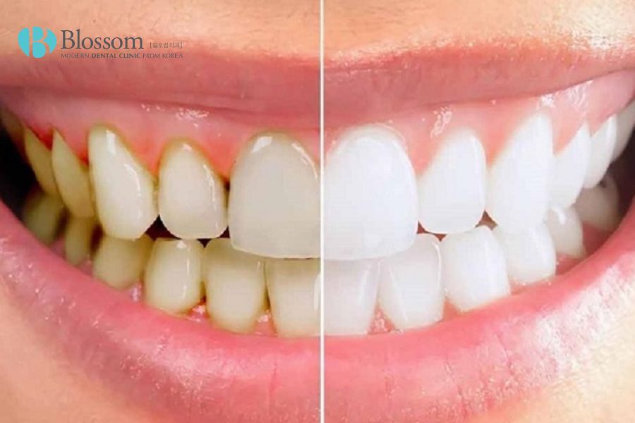 Lấy cao răng giúp hạn chế vi khuẩn phát triển gây viêm lợi trầm trọng. 