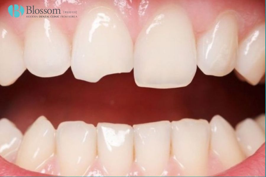 Gãy răng cửa có nhiều trường hợp để đánh giá và khắc phục.