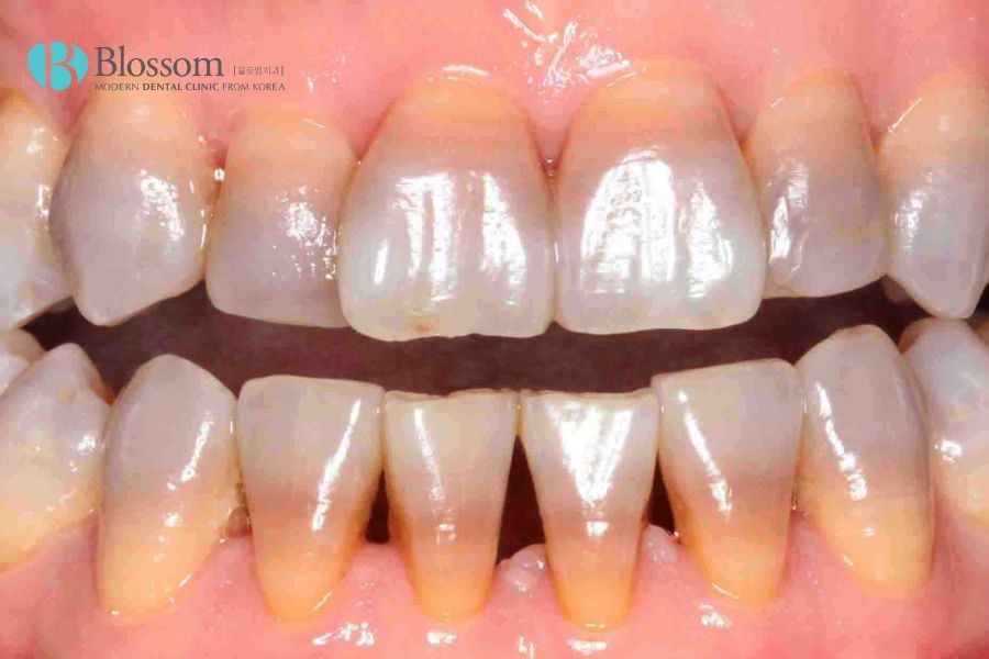 Màu sắc răng ngả vàng là dấu hiệu cho thấy răng xỉn màu.