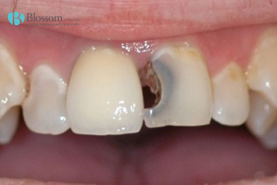 Mẻ răng là điều kiện lý tưởng để vi khuẩn tấn công răng, gây nên các bệnh lý về răng miệng