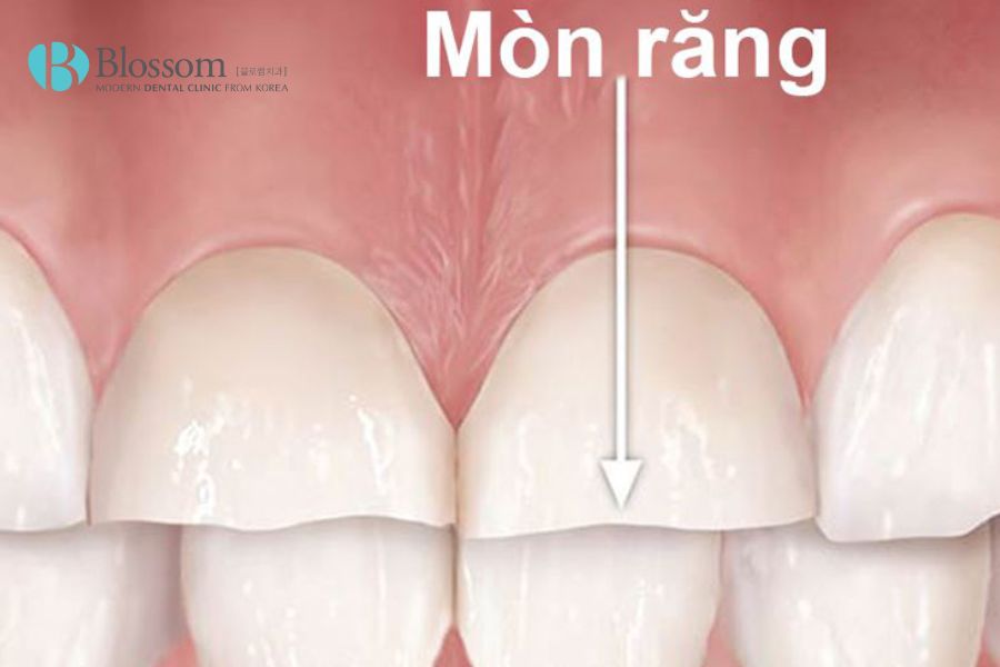 Mòn răng dù không gây quá nhiều đau đớn nhưng ảnh hưởng lớn tới phát âm và cách ăn uống.