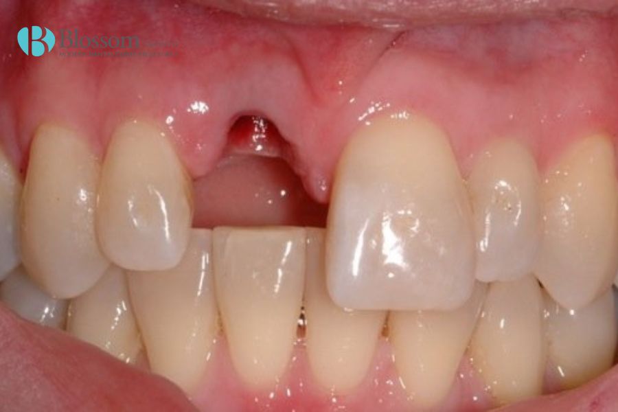 Nên trồng răng hàm trong trường hợp bị lung lay hoặc gãy vỡ