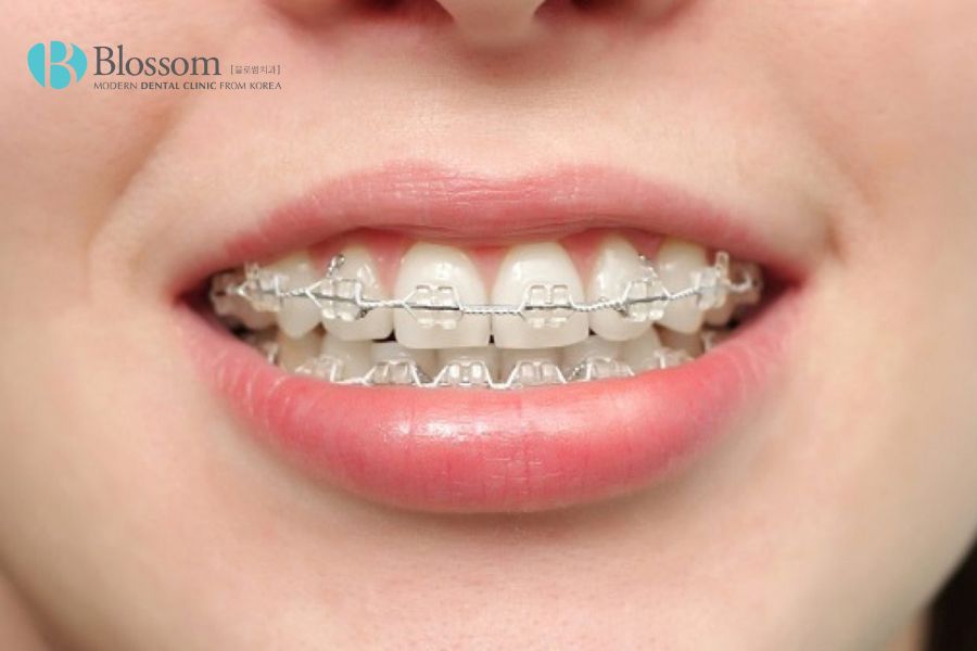 Ngày càng có nhiều người lựa chọn niềng răng để điều trị các trường hợp răng hô.