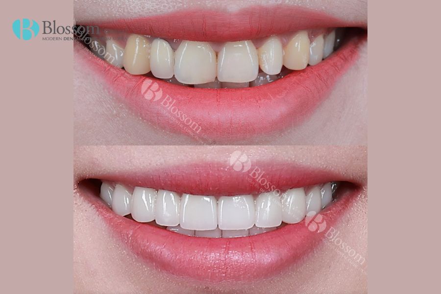 Nha Khoa Blossom có giá dịch vụ làm răng sứ với kỹ thuật Lamifilm cạnh tranh nhất thị trường