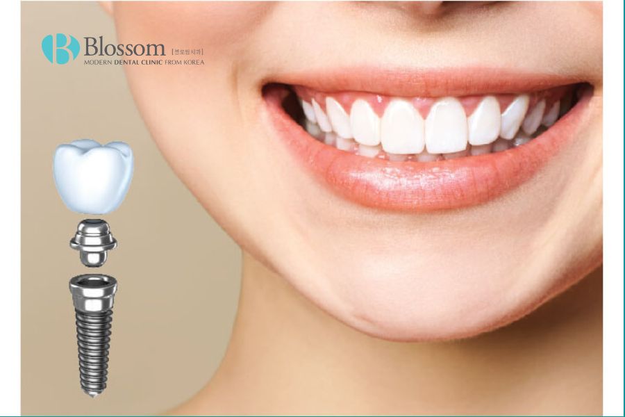 Nha Khoa Blossom luôn sử dụng mão răng sứ và trụ Implant chính hãng.