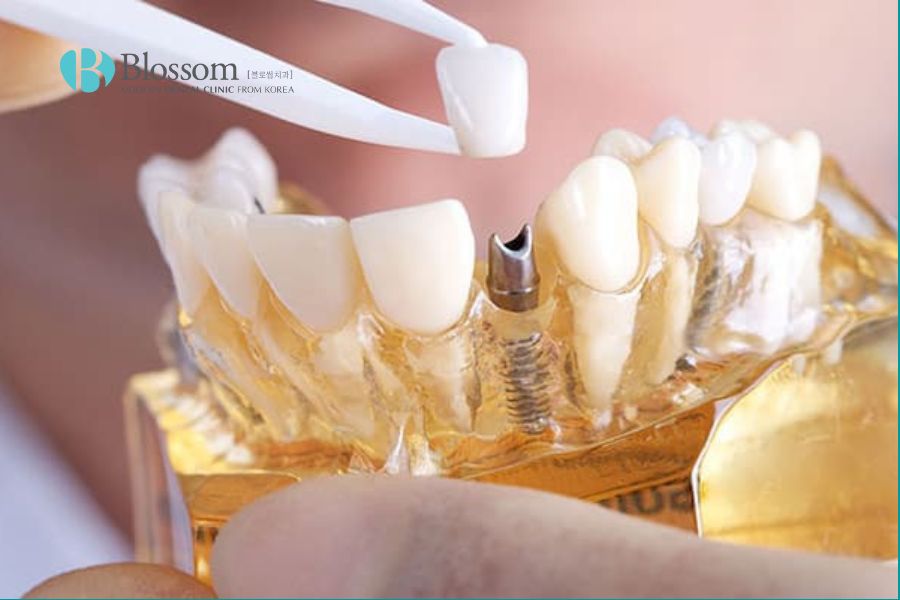 Nha Khoa Blossom luôn sử dụng mão răng sứ và trụ Implant chính hãng.