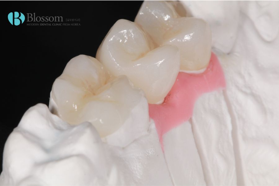 Nha Khoa Blossom sở hữu phương pháp trám răng bị sâu với độ bền cao