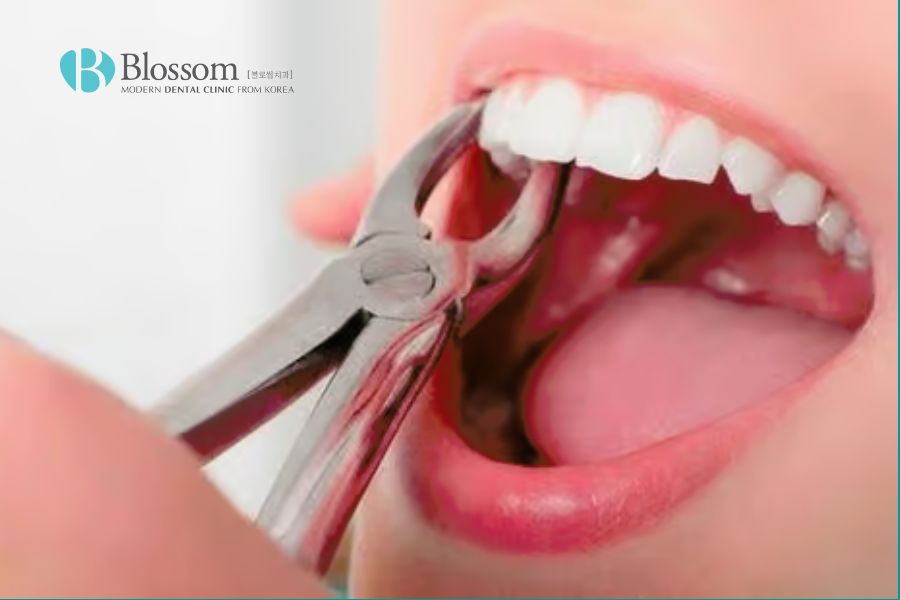 Nhổ răng giúp ngăn ngừa sự lan rộng của nhiễm trùng và các răng khác.