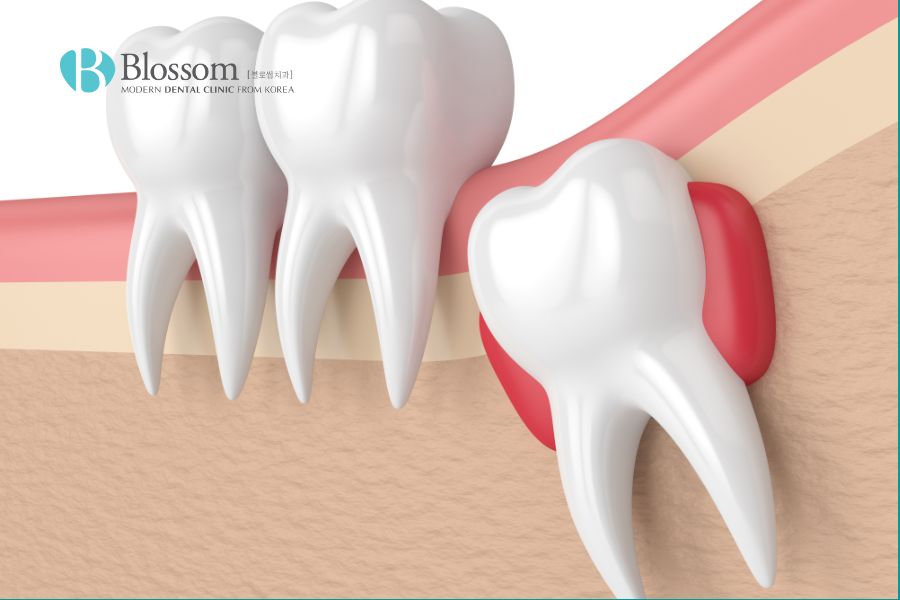 Nhổ răng khôn có thể giúp điều trị viêm nướu.