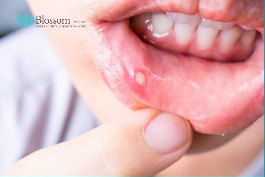 Nổi đẹn ở nướu thường là do vi khuẩn trong mảng bám và chất bã nhờn trên răng gây ra
