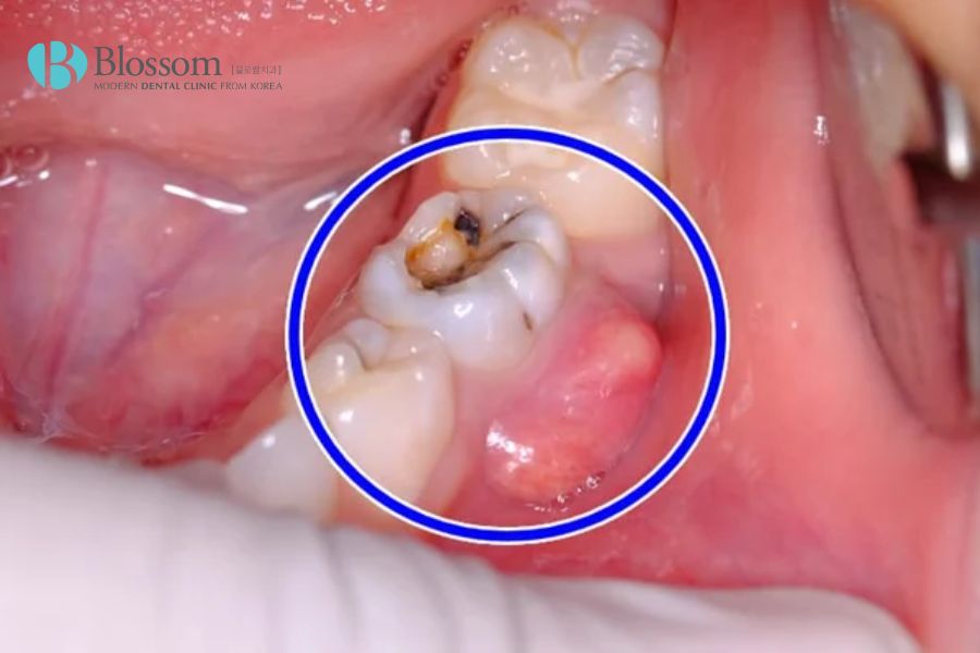 Ổ áp xe răng sẽ khiến vùng hàm sưng do bị chèn ép.