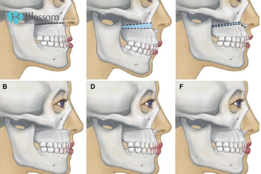 Phẫu thuật cắt xương hàm áp dụng với tình trạng răng hô nặng, phức tạp.