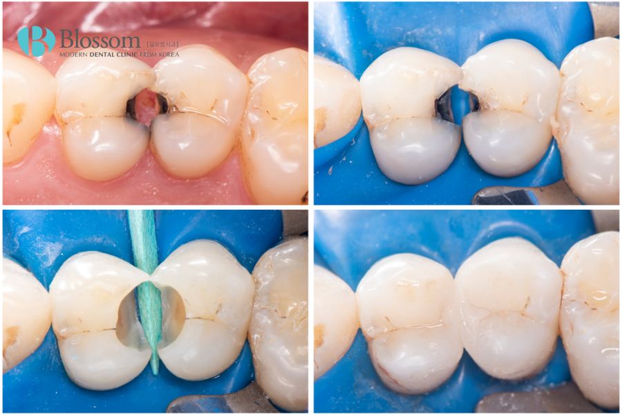 Phương pháp composite giúp trám răng sâu với thẩm mỹ cao