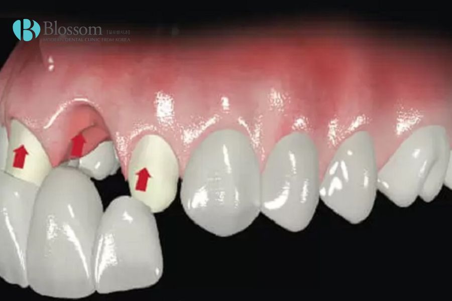 Phương pháp phục hồi răng cửa qua cầu sứ là lựa chọn lý tưởng cho người bị mất răng