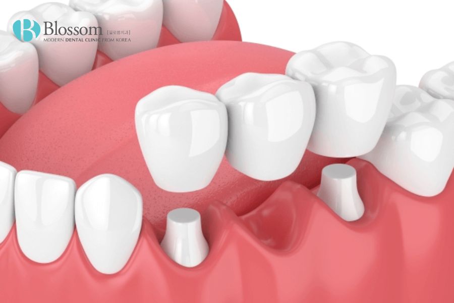 Phương pháp trồng răng hàm bằng cầu sứ đảm bảo ăn nhai và tính thẩm mỹ cho hàm răng