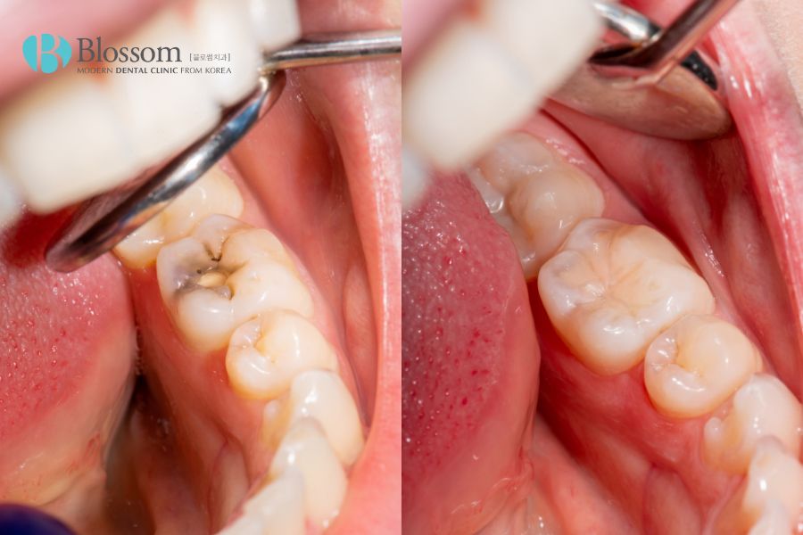 Quy trình trám sâu răng với 5 bước cơ bản