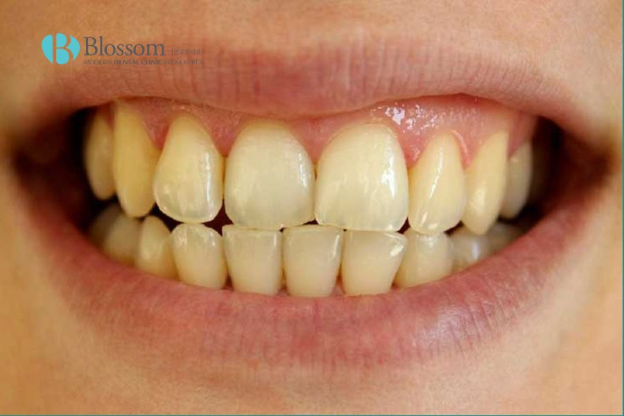 Răng bị ố vàng gây mất thẩm mỹ thiếu tự tin khi giao tiếp.