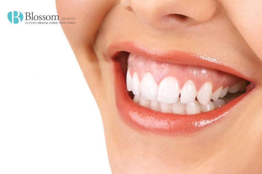Răng hô hở lợi khiến nụ cười lộ khuyết điểm rõ ràng.