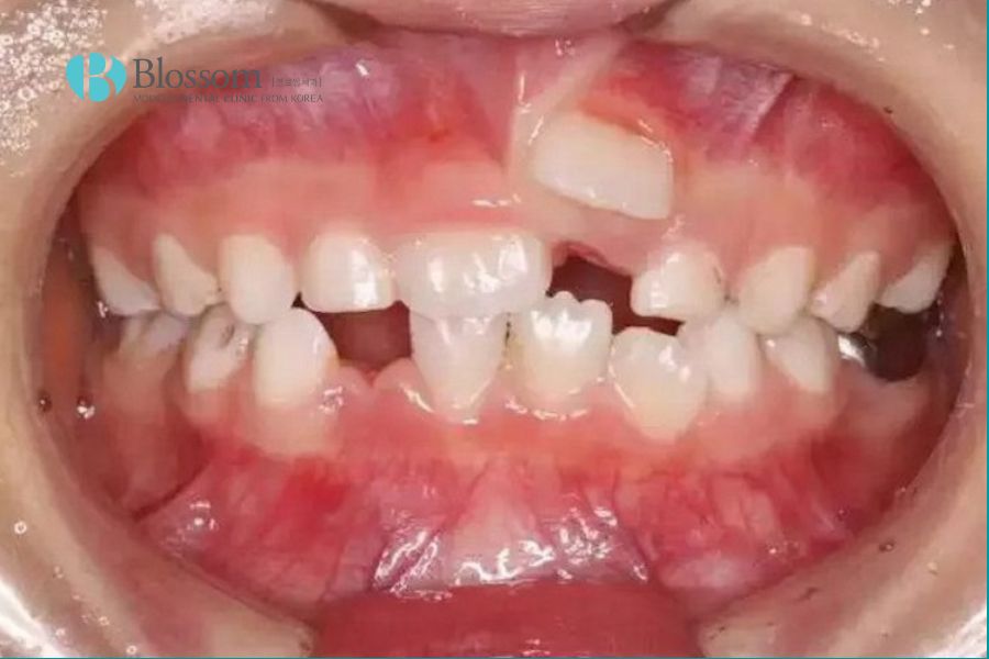 Răng mọc ngược trên lợi cao hơn hẳn so với những răng khác trên cung hàm