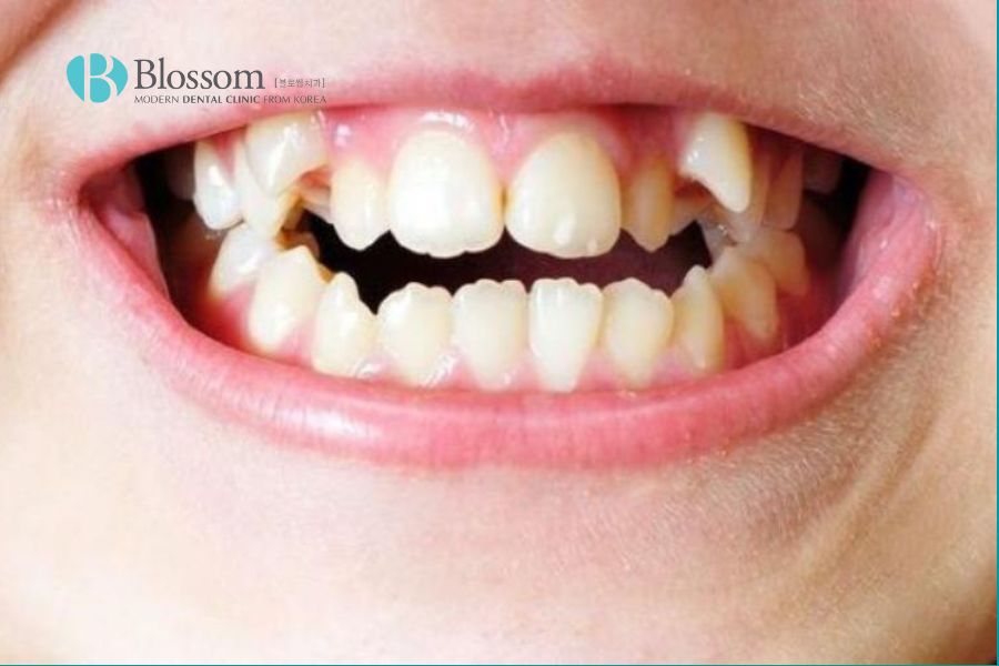 Răng mọc trên lợi là tình trạng răng mọc sai vị trí trên cung hàm.