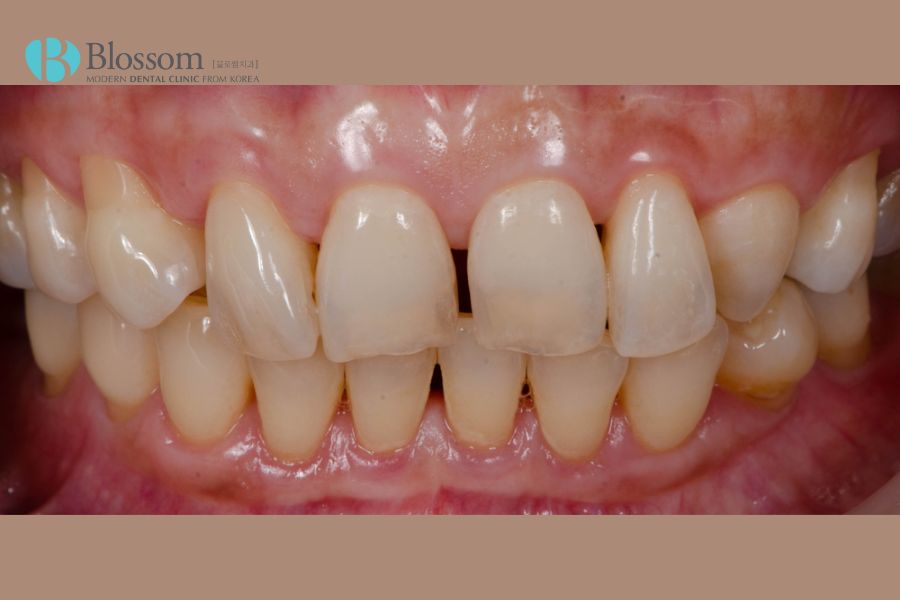 Răng sứ có thể bị mòn theo thời gian nếu không được bảo vệ đúng cách