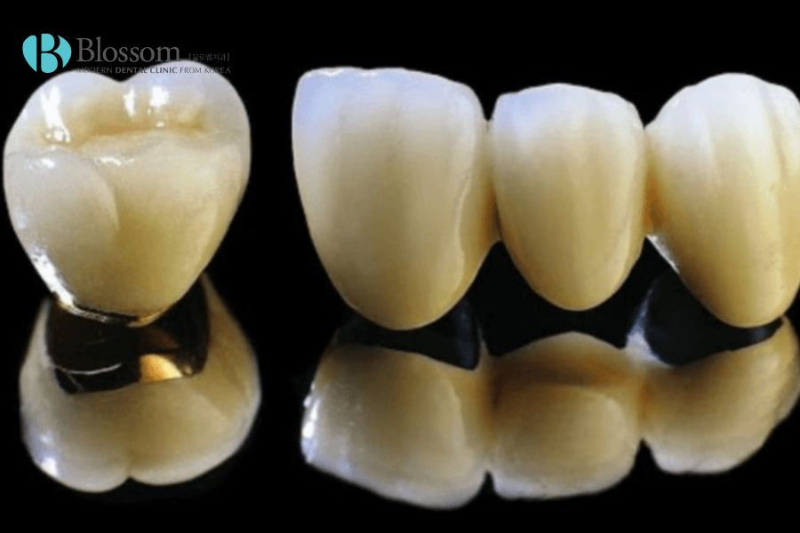Răng sứ kim loại giúp hoạt động ăn nhai tốt