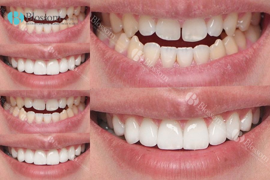 Răng trở nên sáng đẹp sau khi dán răng sứ